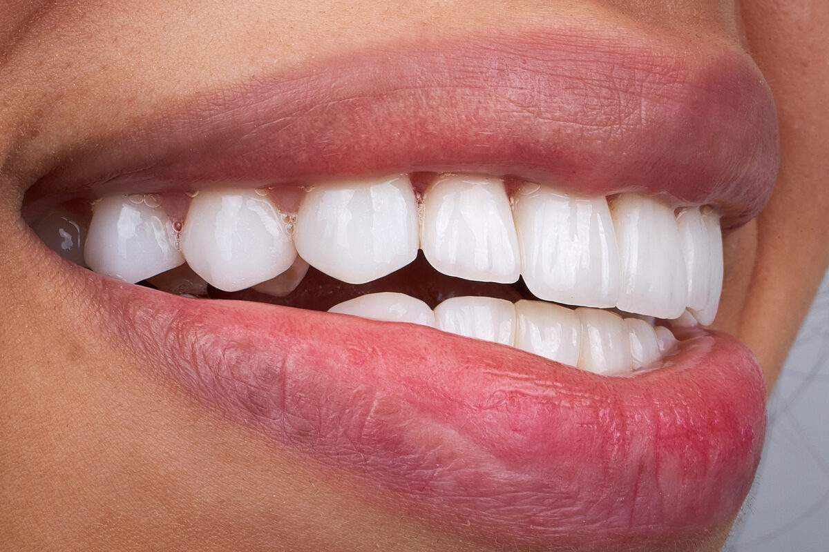 Porcelain Veners in Turkey with Dental Clinic Turkey