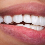 Porcelain Veners in Turkey with Dental Clinic Turkey