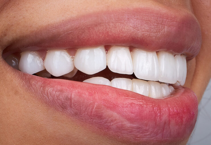 Porcelain Veners in Turkey with Dental Clinic Turkey