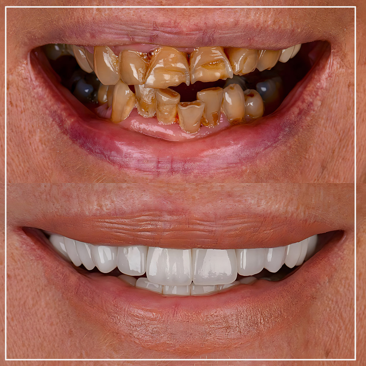 Porcelain Veneers Turkey