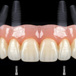 dental implant brands