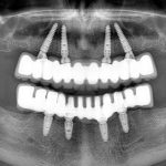 full arch all on 4 dental treatment