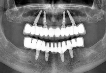 full arch all on 4 dental treatment