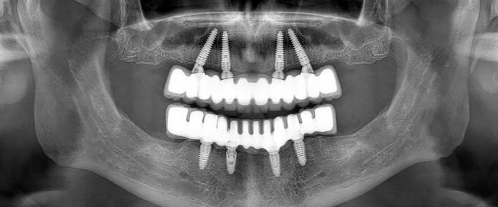 full arch all on 4 dental treatment