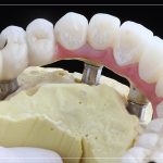 All on 4 Before After Dental Implants