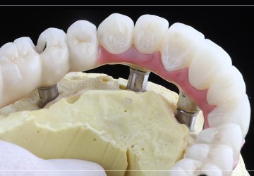 All on 4 Before After Dental Implants