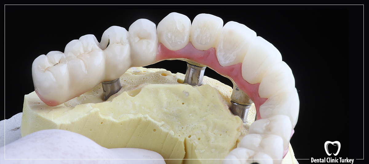 All on 4 Before After Dental Implants