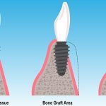 Bone Grafting