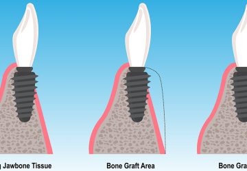 Bone Grafting