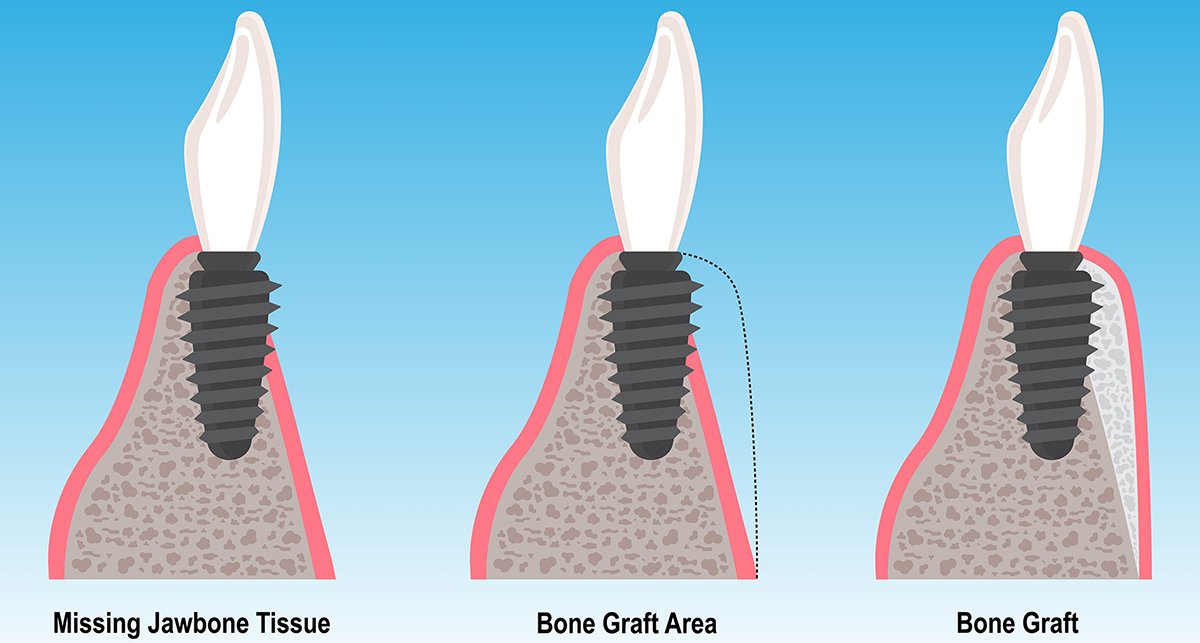 Bone Grafting
