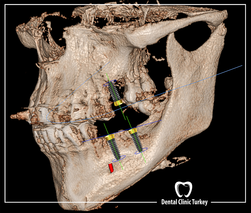 Bone Grafting and Tomography
