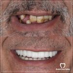 Dental Implants and Bone Grafting Quality