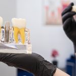 Dental Implant Benefits