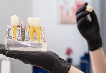 Dental Implant Benefits