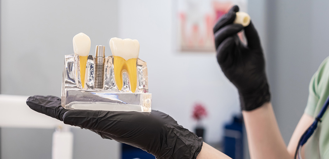 Dental Implant Benefits