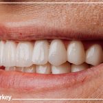 Screwless Dental Implants