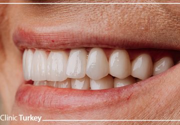 Screwless Dental Implants