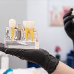 Jawbone Short Implant