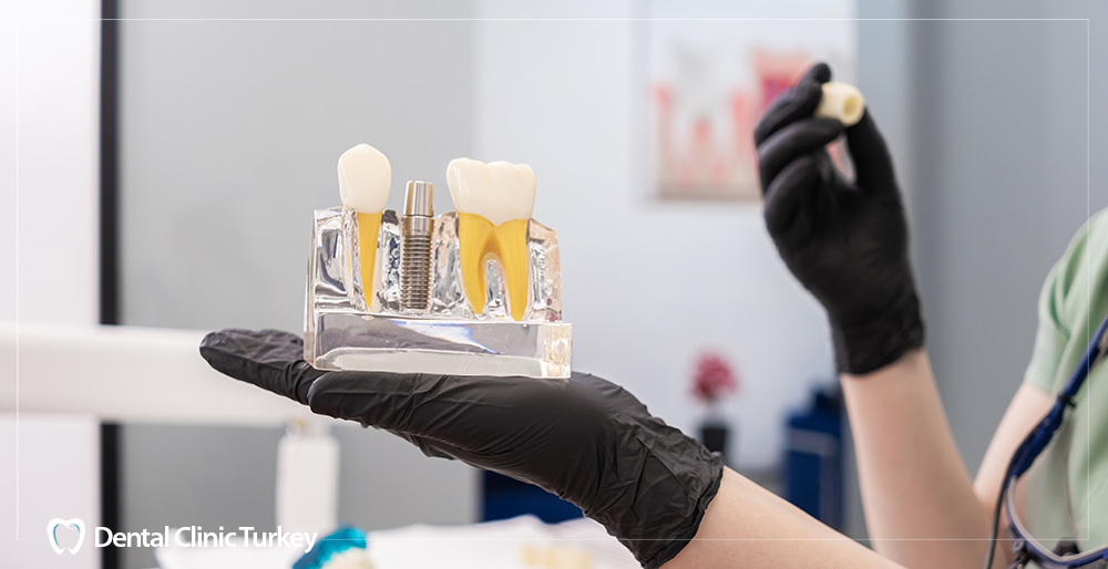 Jawbone Short Implant