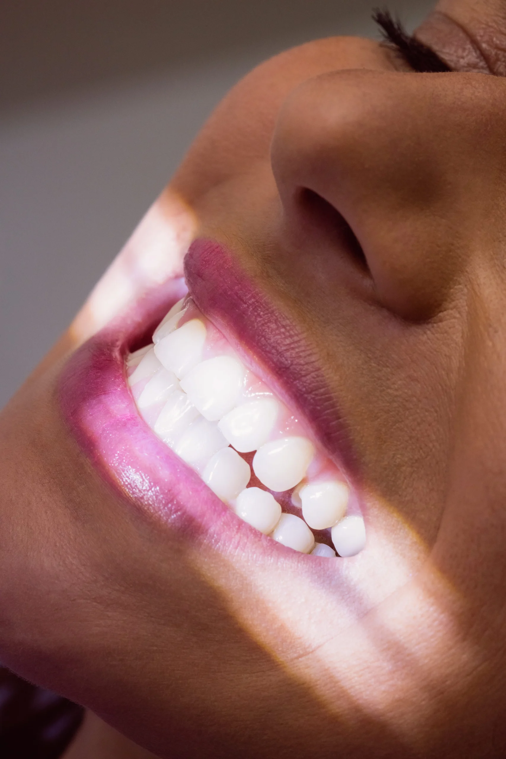 E-max veneers Turkey - natural translucency result