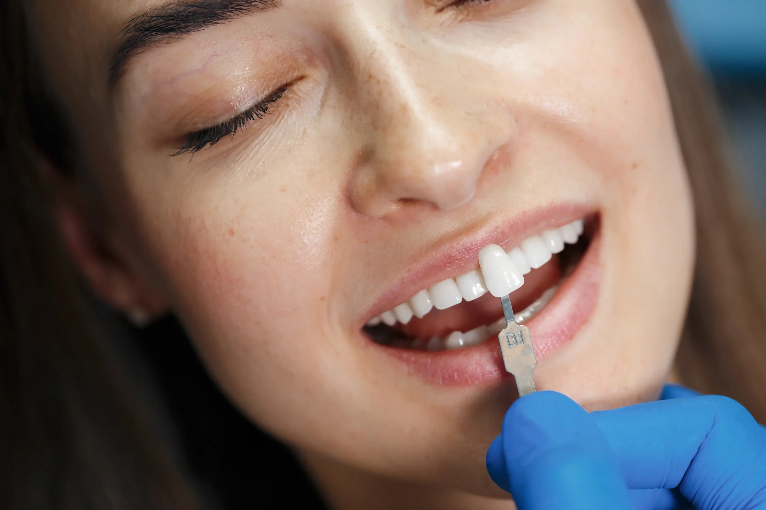 Zirconium Crowns in Turkey: Cost, Quality and What to Expect