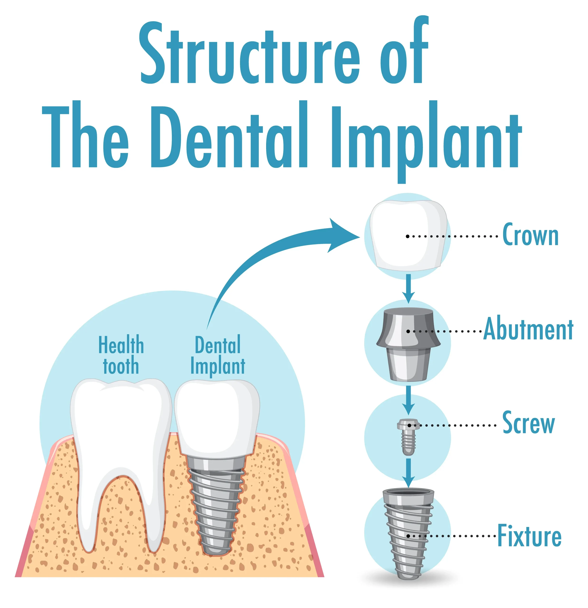 Dental implant treatment process in Antalya Turkey