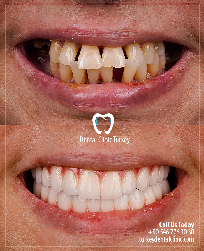 Full Smile Makeover in Turkey with Porcelain Veneers for Woman