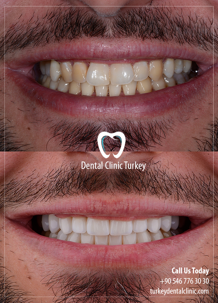 Full Smile Makeover in Turkey with Porcelain Veneers