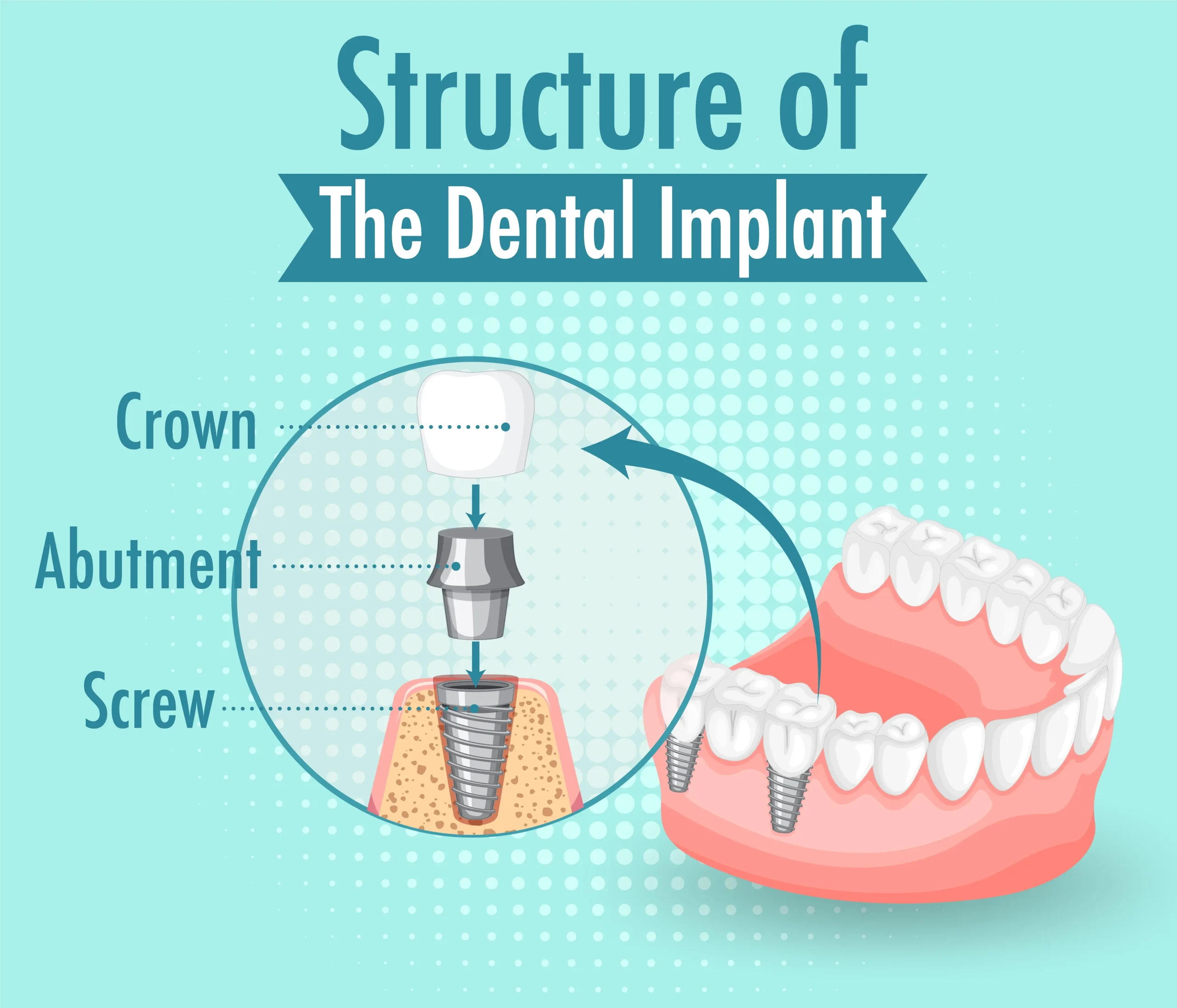 Structure of dental implants All-on-4 All-on-6 Turkey